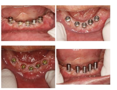 5 implants post op 4 mois cb4ezm - Eugenol