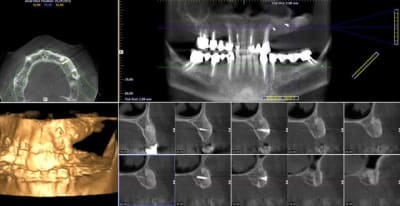 5 mois post op vewvnl - Eugenol