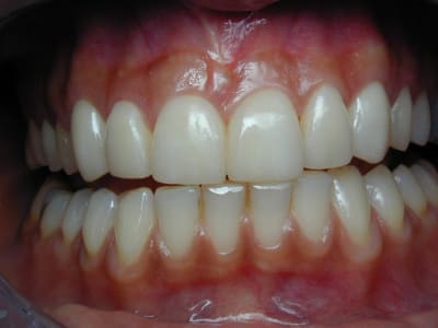 6 facettes feldspathiques xgvmmk - Eugenol