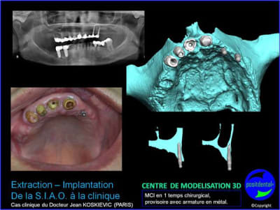 8 extraction mci bridge provisoire avec armature m tal wfexah - Eugenol