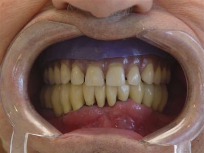 91 ans essai infructueux pnbzge - Eugenol