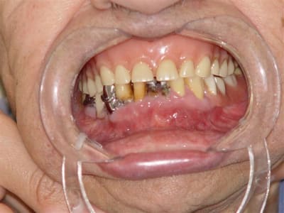 91 ans que faire début mwr2br - Eugenol