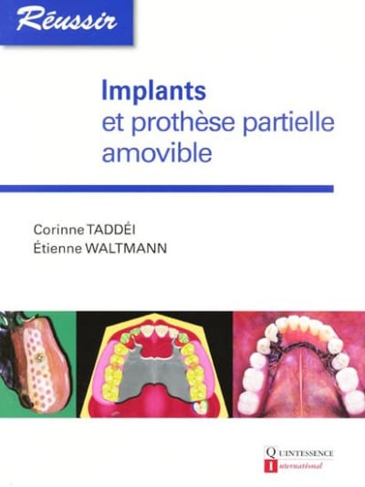 9782912550729 implants protheses partielle amovible g f2q8dz - Eugenol