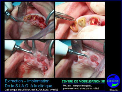 9 extraction mci bridge provisoire avec armature m tal sajjho - Eugenol