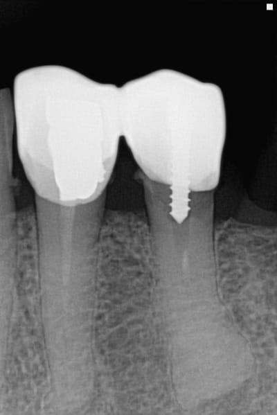 Apex ix6jst - Eugenol