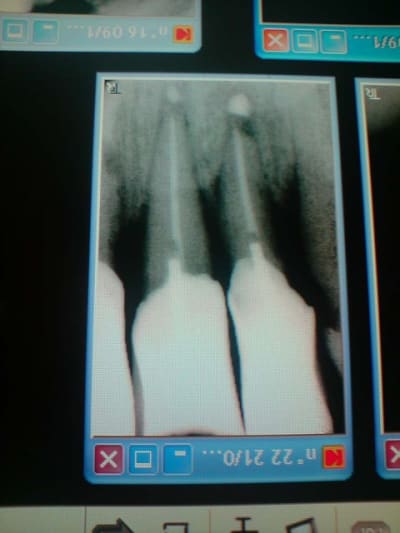 Bic max mpnl53 - Eugenol