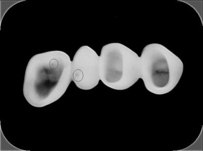 Bridge titane yxlm6m - Eugenol