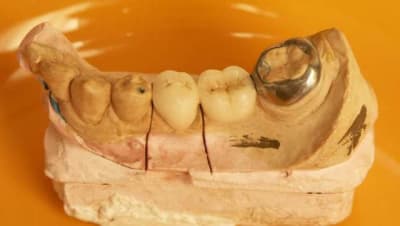 Bridge collé mixte 6 bh4uls - Eugenol
