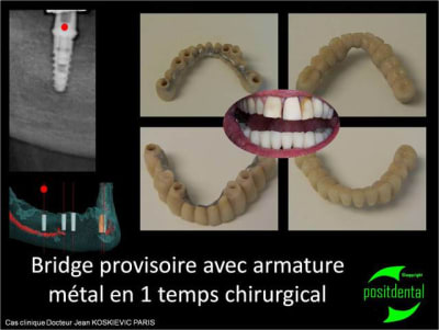 Bridge provisoire avec armature m tal en 1 temps chirurgical gm9gel - Eugenol