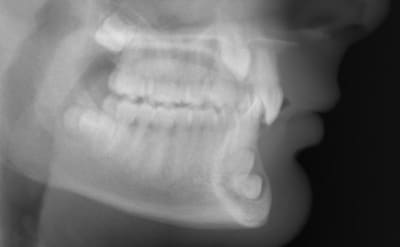 Canines 14 ans b  emt7bb - Eugenol