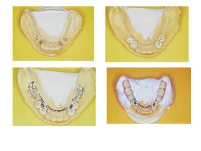 Cas sur implants xm3y0e - Eugenol