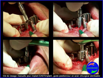 Cl  de vissage manuelle pour implant easyimplant   guide positionneur en acier chirurgical st rilisable hb9da9 - Eugenol