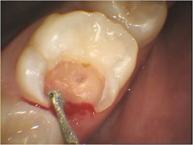 Coiffage pulpaire - Eugenol