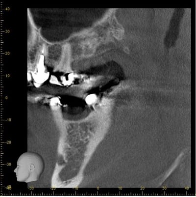 Coupe 3 implant 46 q2ppoo - Eugenol