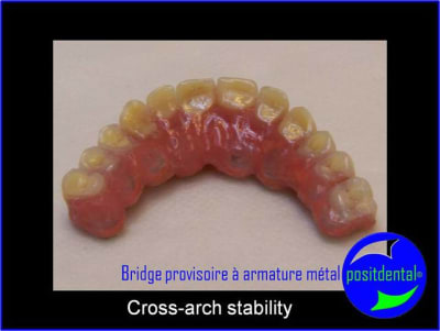 Cross arch stability tz4d2v - Eugenol