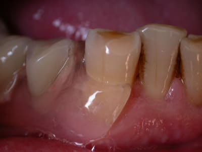 Deflex e n bouche ao5giy - Eugenol