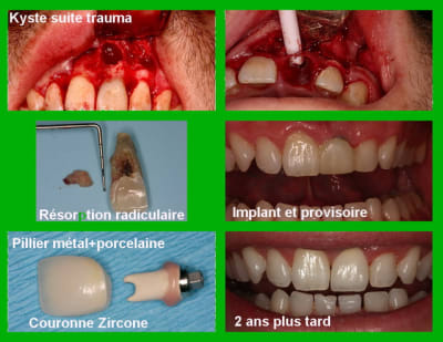 Dent 21 montage 2  dasmbc - Eugenol