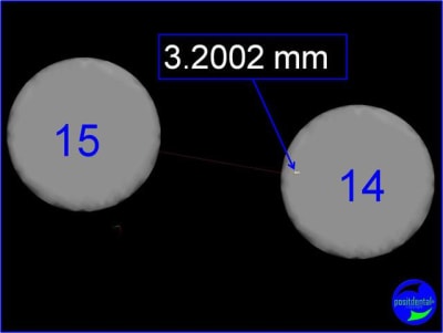 Distance entre 2 implants dhl6qj - Eugenol