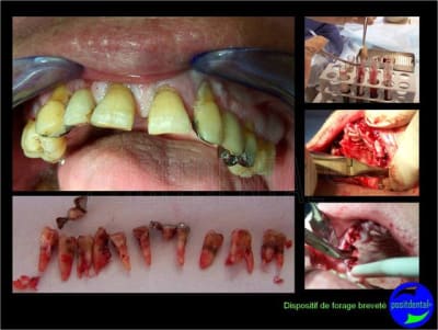 Eimci et canine incluse positdental 07 f0wc4r - Eugenol