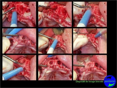 Eimci et canine incluse positdental 08 s1ojgg - Eugenol
