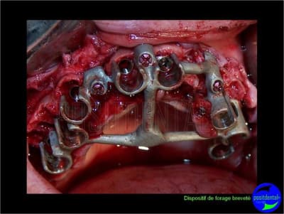 Eimci et canine incluse positdental 09 b4vwp6 - Eugenol