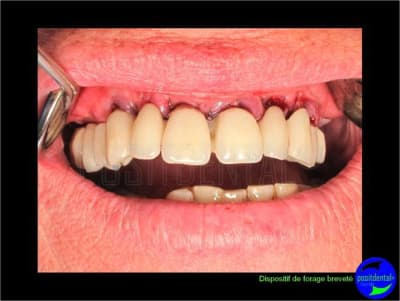 Eimci et canine incluse positdental 12 wnbvhc - Eugenol