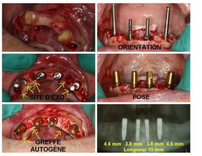 Exo 4 implants  custom  r2s69y - Eugenol