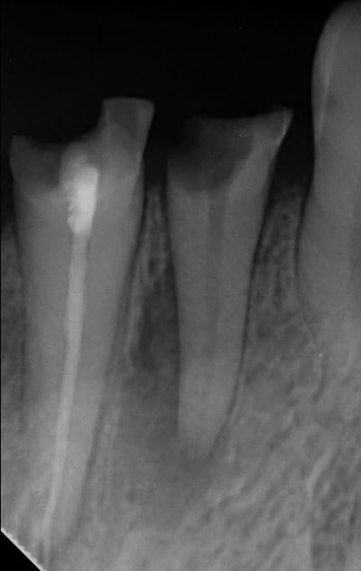 Endo 1  1   preop f9tl26 - Eugenol