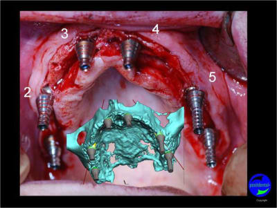 Expansion  condensation guid e  positdental 01 wglehw - Eugenol