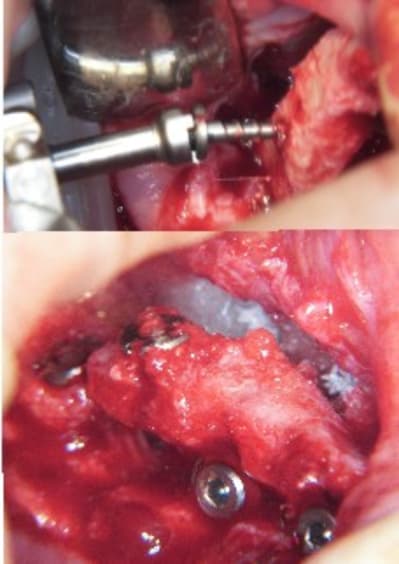 Expansion osseuse et vis bdkhc4 - Eugenol