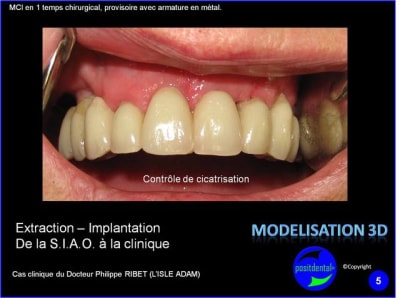 Extraction   implantation   mod lisation 3d positdental  16 j3yewh - Eugenol