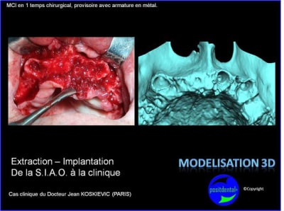 Extraction   implantation   mod lisation 3d positdental  2 ialnbn - Eugenol