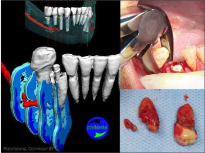 Guide chirurgical positdental 08 bqto2u - Eugenol