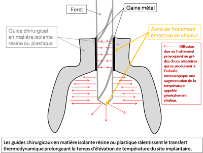 Guide chirurgical et irrigation pb2yal - Eugenol