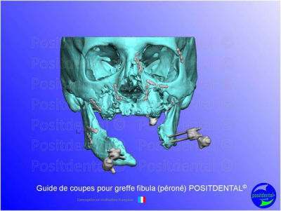 Guide de coupes pour greffe fibula  p ron   positdental 001 kmhxis - Eugenol