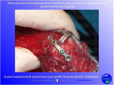 Guide de coupes pour greffe fibula  p ron    positdental 022 z0c7mr - Eugenol