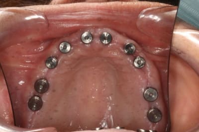 Haut  10 imlants  uum6ql - Eugenol