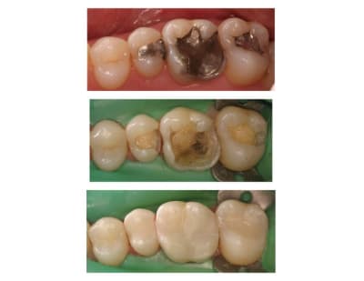 Hg ou compo v2glhc - Eugenol