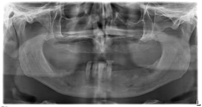 Implanto djavln - Eugenol