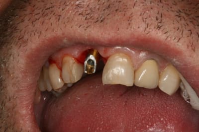 Implant 11 007 gryeir - Eugenol