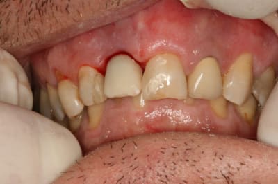 Implant 11 009 ssbkyt - Eugenol