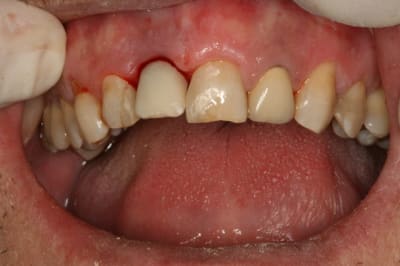 Implant dent 11 010 geibyc - Eugenol