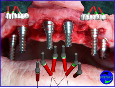 Image11 positdental mujzrv - Eugenol