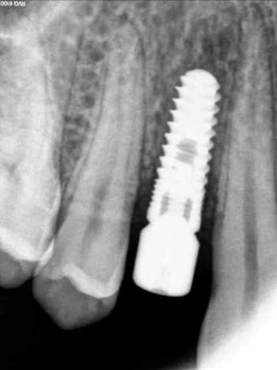 Implant 14 fsid3x - Eugenol