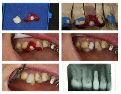 Implant 15 tnidxc - Eugenol