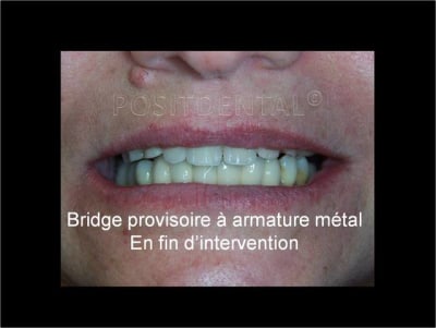 Implant dentsply ankylos et mci 12 fns7pw - Eugenol