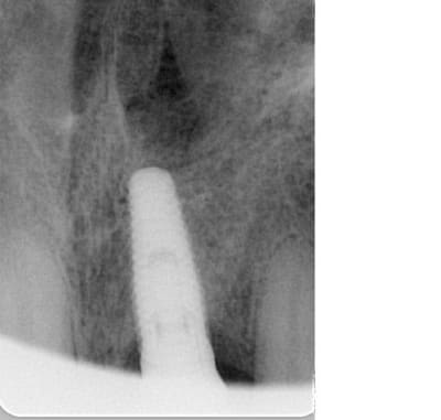 Implant le j cam1ll - Eugenol