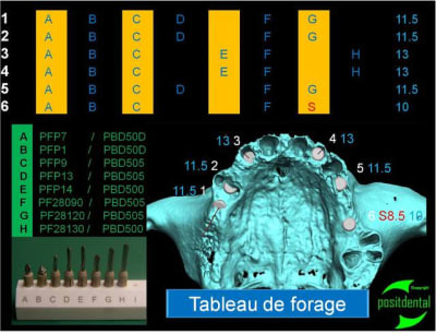 Implant angul  positdental 16 iggodk - Eugenol