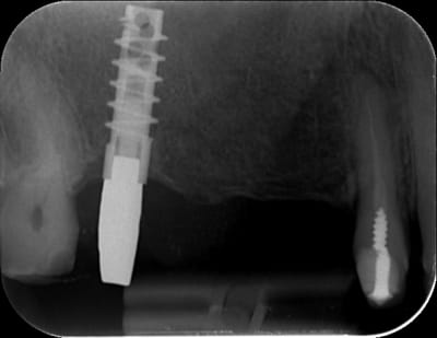 Implant fjjxvc - Eugenol