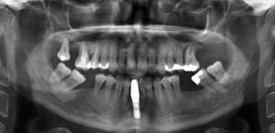 Implant inconnu 1 jw6fqu - Eugenol